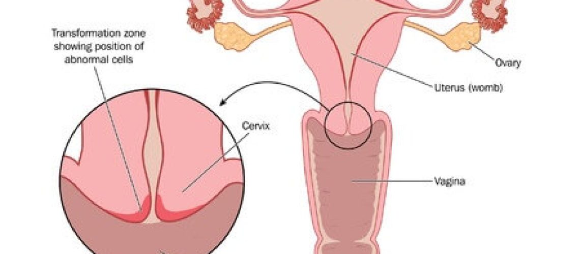 בדיקת צוואר הרחם